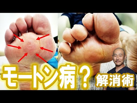【モートン病】　足の付け根の痛みを和らげるマッサージ【川崎市の外反母趾治療家 バイタルあきやま】