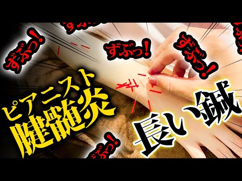 【手首　腕の痛み　緊急治療】最悪、ピアニストで手首の痛みは致命的。大量の鍼がよいか？1本の鍼がよいのか？　ピアノは弾けるようになるのでしょうか？【鍼灸院　ブレア銀座　ブレア元町】