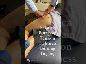 Sciatic Nerve Entrapment at the deep gluteal space (posterior hip)