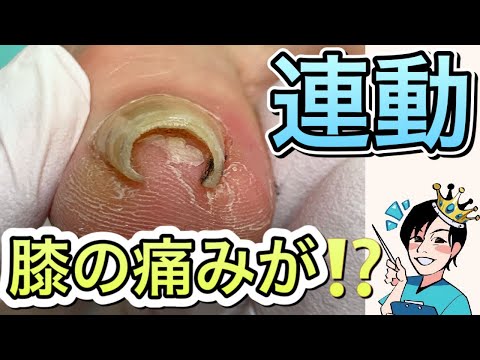 巻き爪矯正で膝の痛みが改善