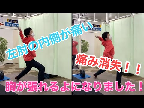 野球肘（内側）痛み撃沈ビフォーアフター