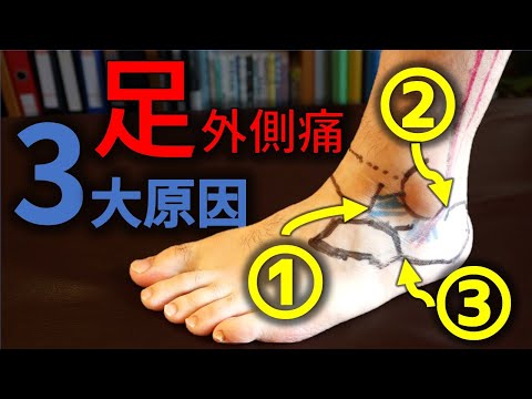 【足外側が痛い】3大原因とは！？一目で分かるように可視化してみた