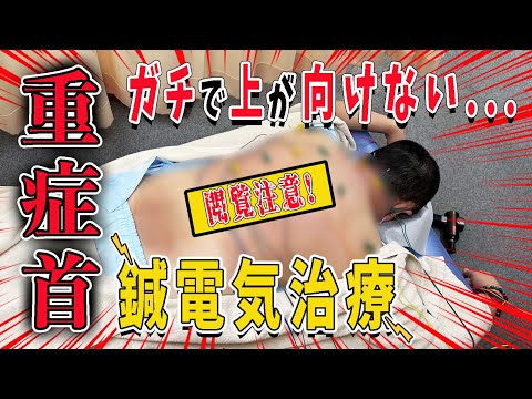 【鍼治療】上がガチで向けない重症な首を鍼と電気で治療！首の痛みをとる！