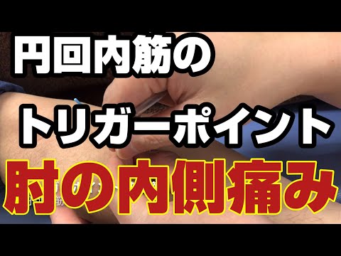 円回内筋のトリガーポイント鍼治療、野球肘、内側上顆炎、手首の痛み